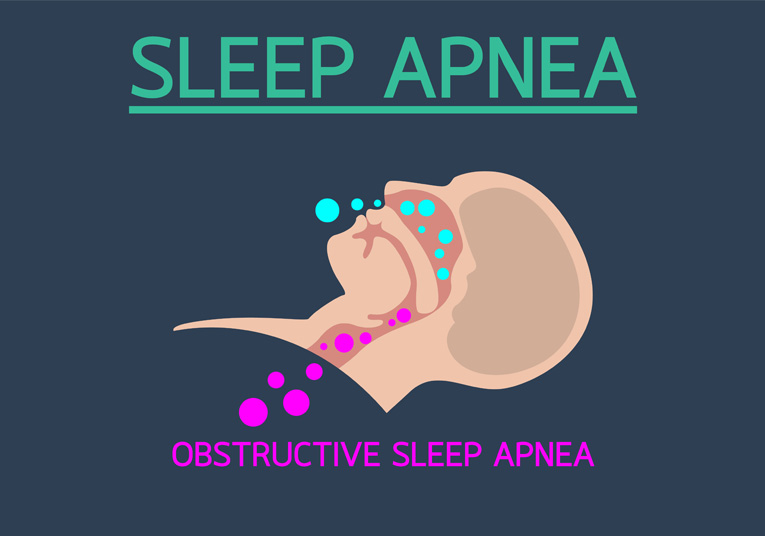 OBSTRUCTIVE SLEEP APNEA (OSA)